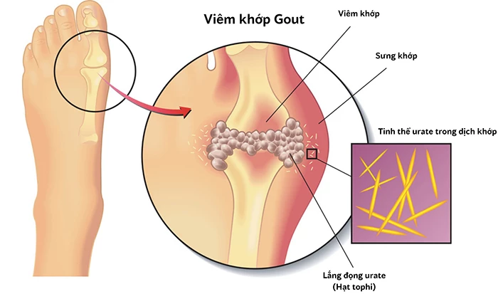 Acid uric cao là bệnh gì