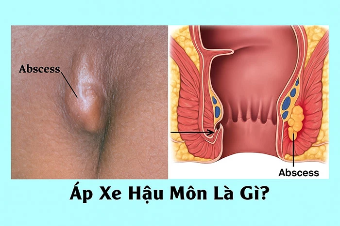 Áp xe hậu môn là gì