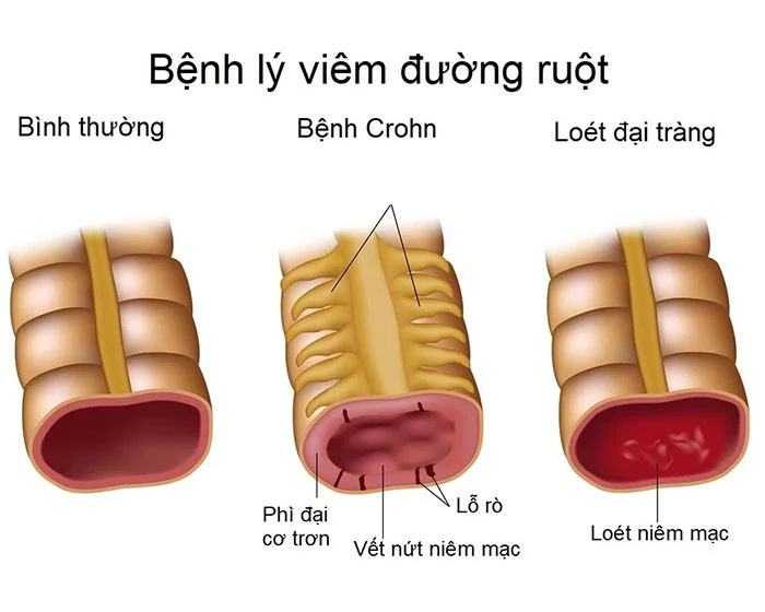 Bệnh Crohn là gì