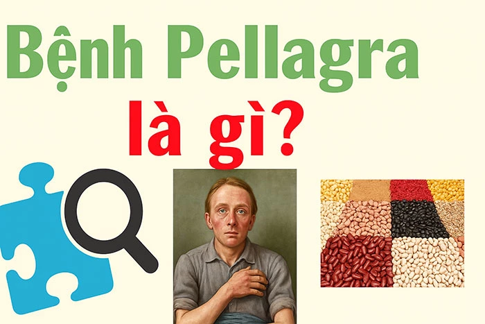 Bệnh Pellagra là gì