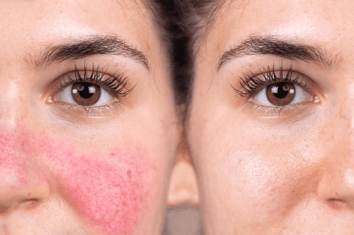 Bệnh Rosacea là gì?
