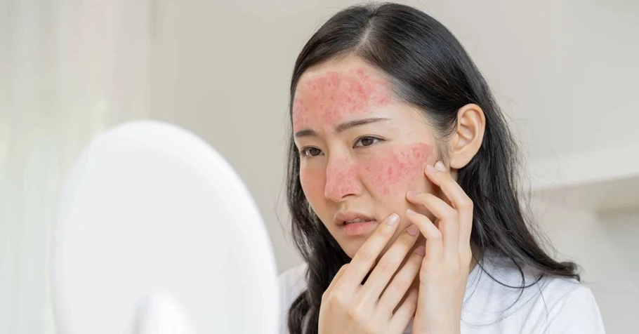 Mụn trứng cá đỏ (Rosacea)