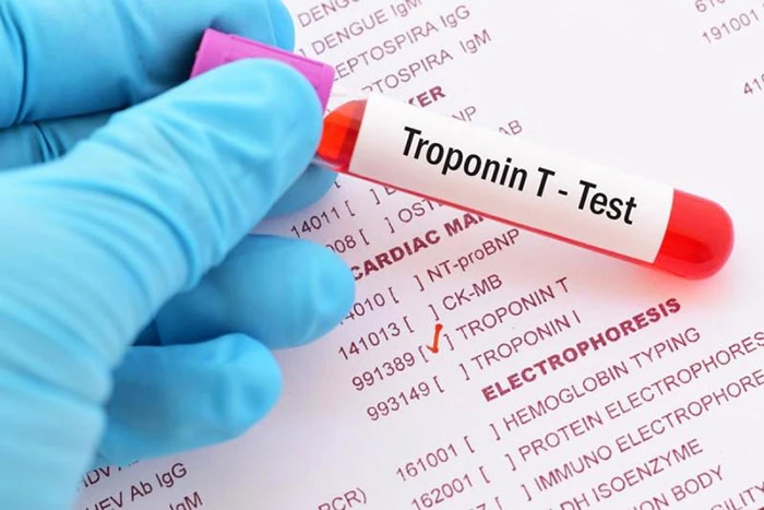 Chẩn đoán nhồi máu cơ tim