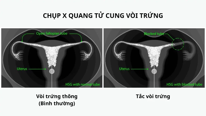 Chẩn đoán tắc vòi trứng