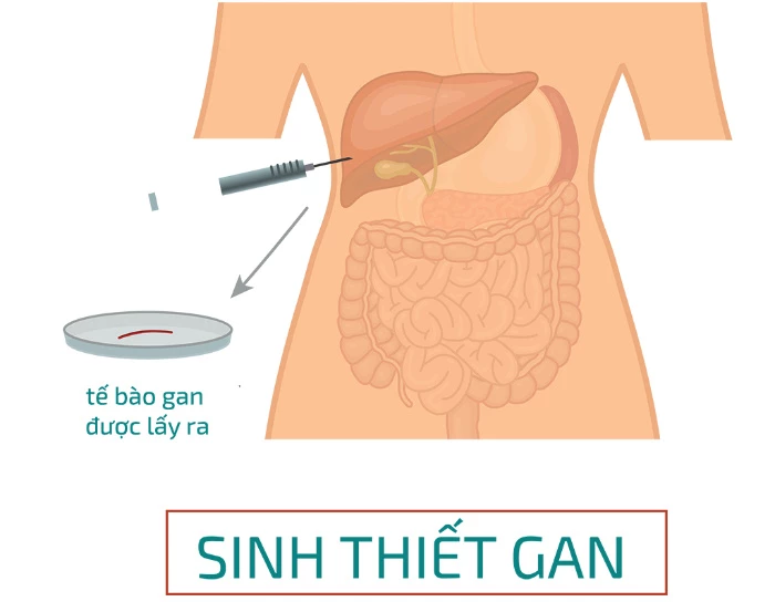 Chẩn đoán xơ gan