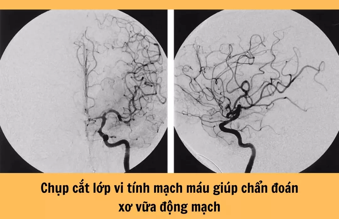 Chẩn đoán xơ vữa động mạch