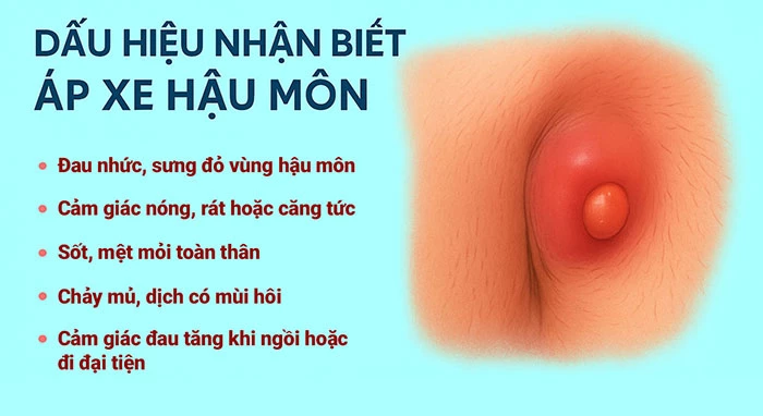 Dấu hiệu nhận biết áp xe hậu môn