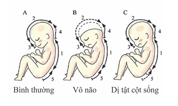 Dị tật ống thần kinh là gì