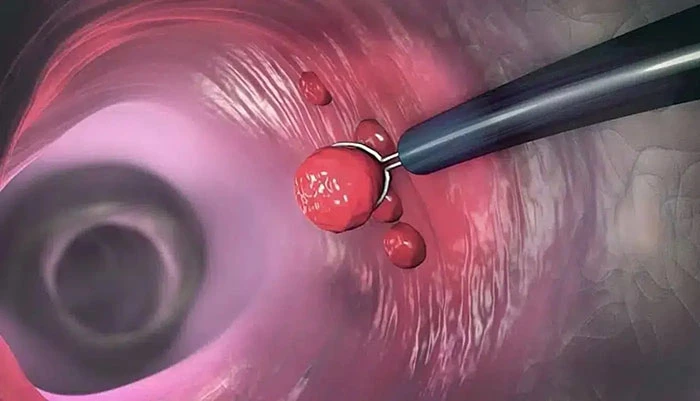 Điều trị polyp trực tràng