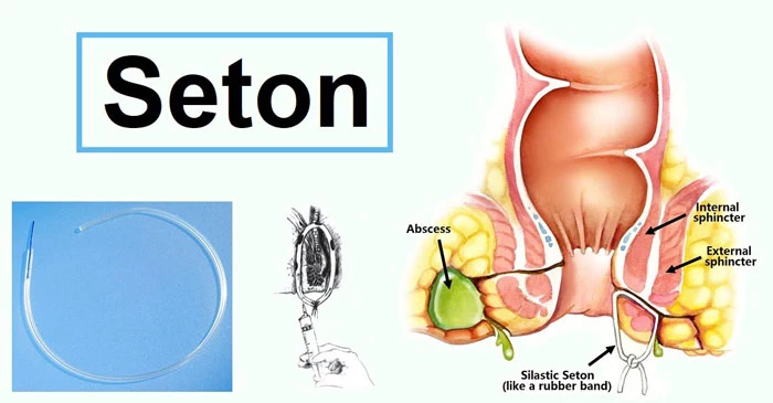 Điều trị rò hậu môn