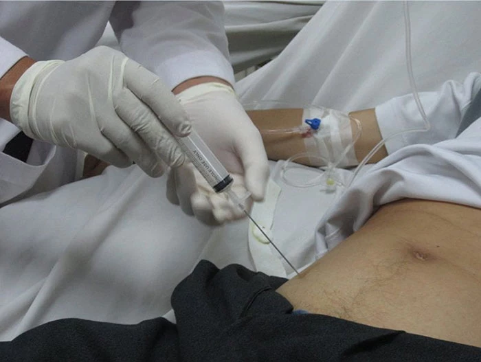 Điều trị xơ gan cổ trướng