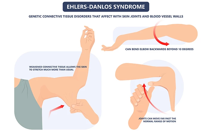 Hội chứng Ehlers-Danlos là gì