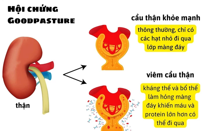 Hội chứng Goodpasture là gì