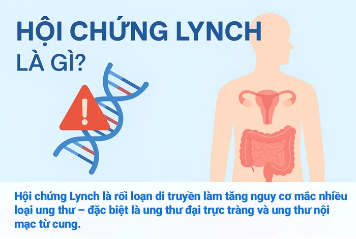Hội chứng Lynch là gì