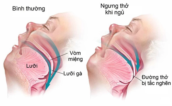 Hội chứng ngưng thở khi ngủ là gì