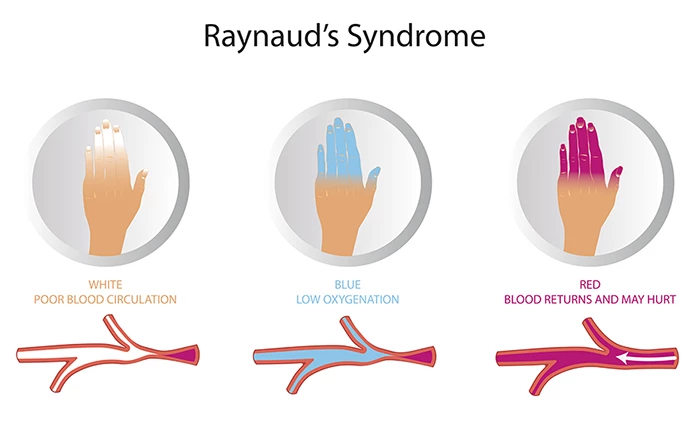Hội chứng Raynaud là gì