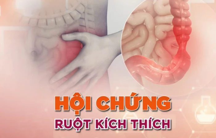 Hội chứng ruột kích thích (IBS) là gì