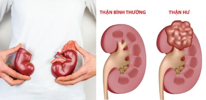 Hội chứng thận hư là gì