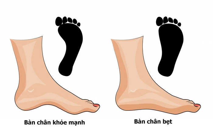 Kiểm tra bàn chân bẹt