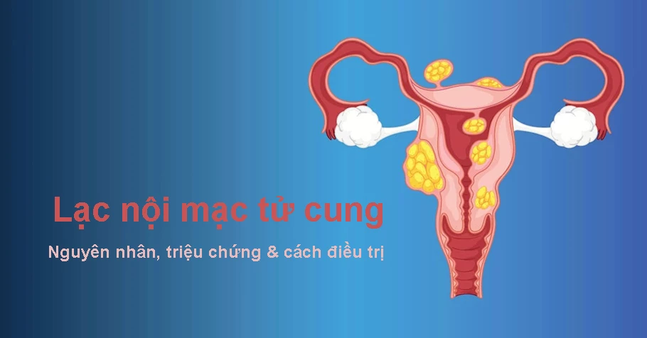 Lạc nội mạc tử cung