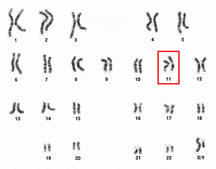 Nguyên nhân gây hội chứng Beckwith-Wiedemann 