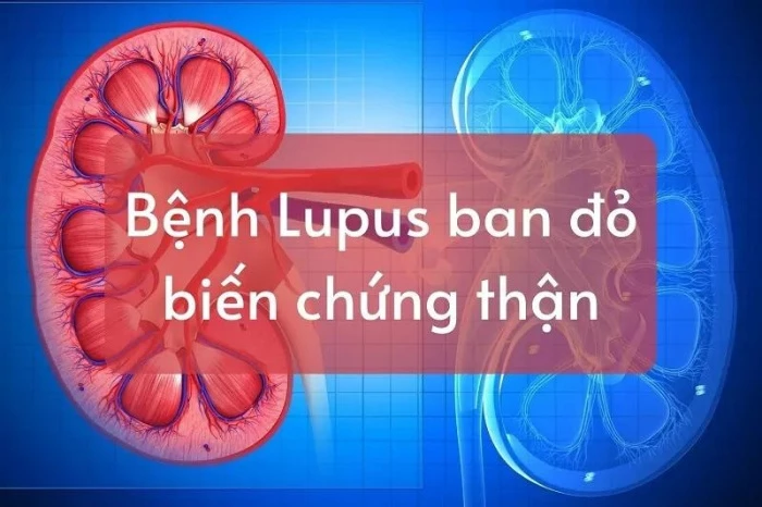 Nguyên nhân gây hội chứng thận hư