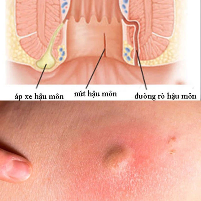 Nguyên nhân gây rò hậu môn