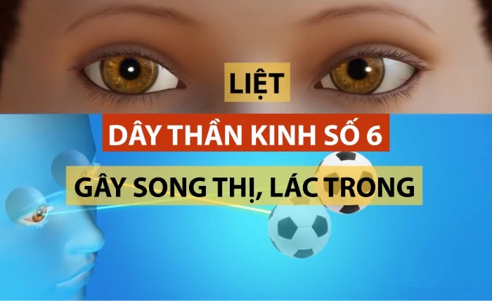 Nguyên nhân gây song thị (nhìn đôi)