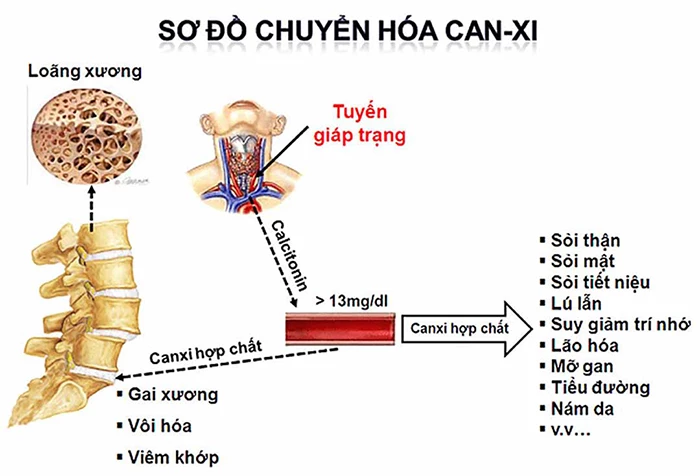 Nguyên nhân tăng canxi máu