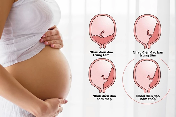 Nguyên nhân thai chậm phát triển trong tử cung