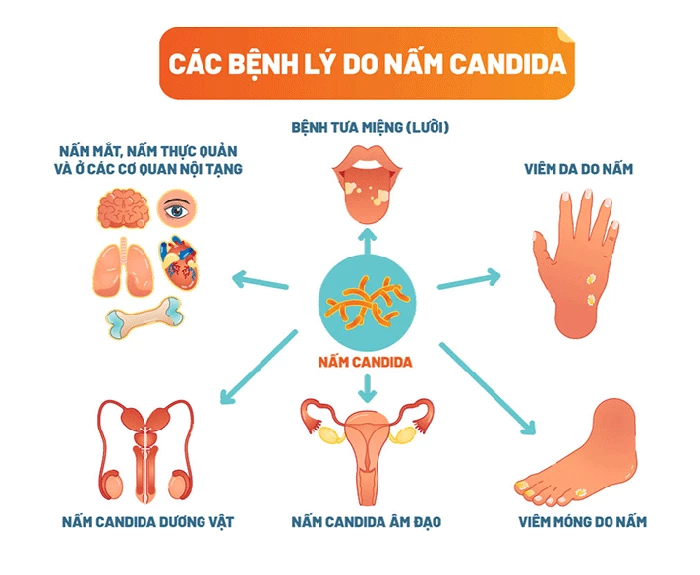 Nhiễm nấm Candida là gì