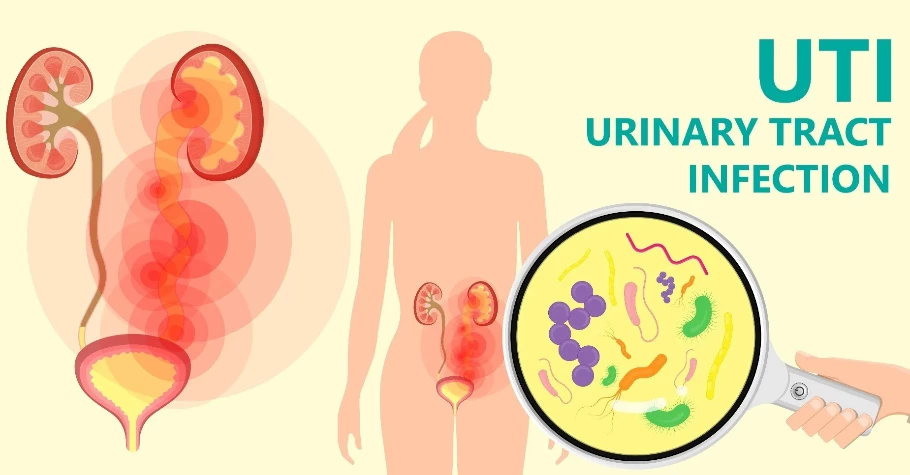 Nhiễm trùng đường tiết niệu (UTI)