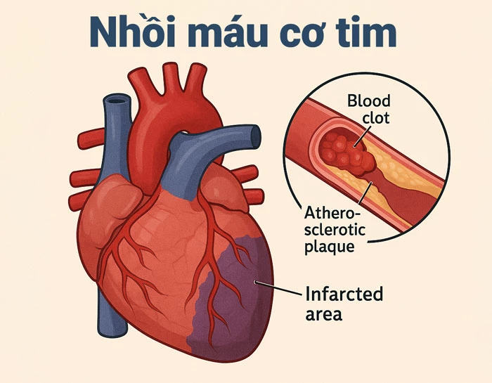 Nhồi máu cơ tim là gì