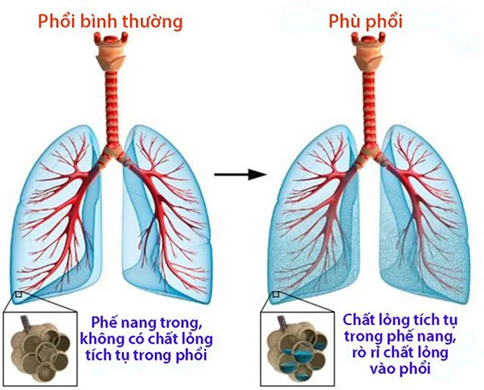 Phù phổi cấp là gì?