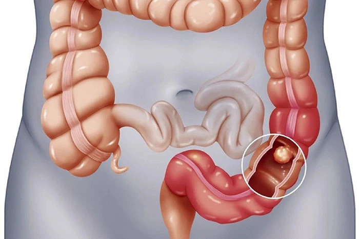 Polyp trực tràng là gì