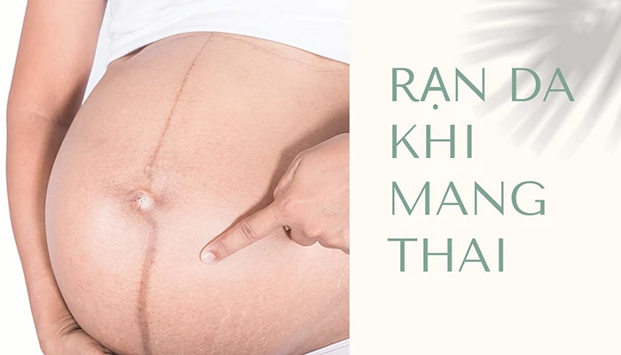 Rạn da khi mang thai xuất hiện khi nào