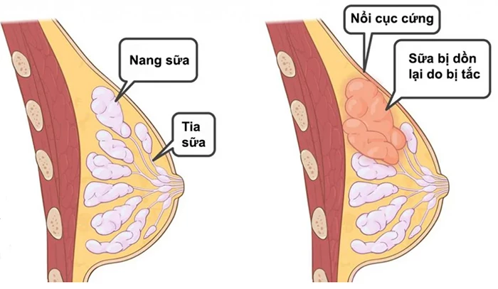 Tắc tia sữa là gì