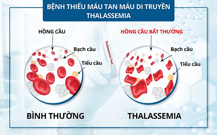 Thalassemia (Tan máu bẩm sinh) là gì