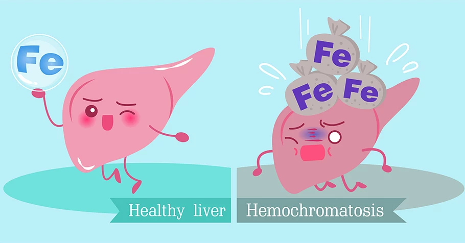 Thừa Sắt: Nguyên Nhân, Dấu Hiệu, Triệu Chứng & Cách Điều Trị