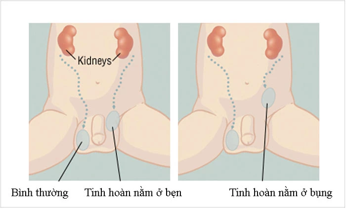 Tinh hoàn ẩn là gì