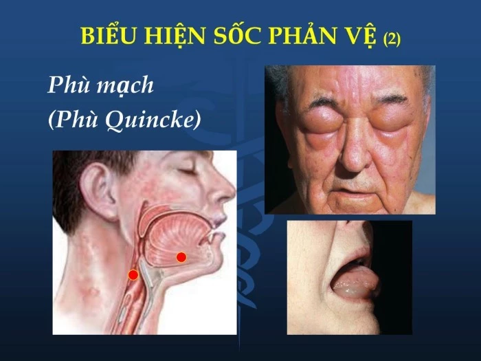 Triệu chứng, dấu hiệu nhận biết sốc phản vệ