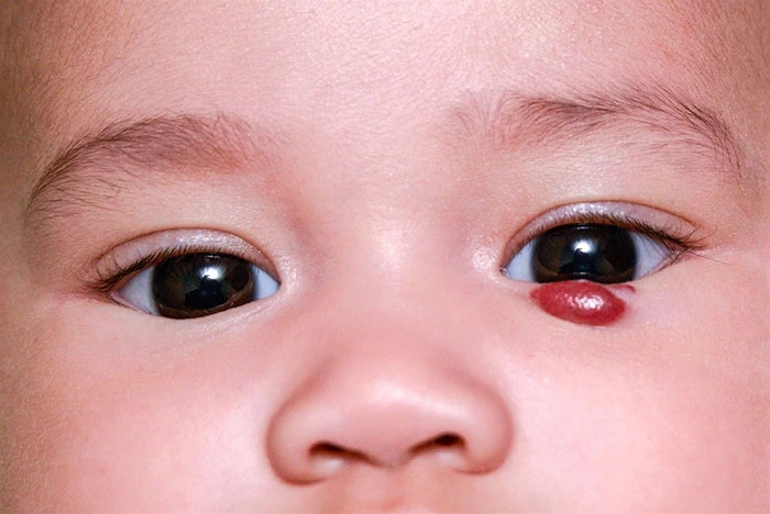 Triệu chứng và dấu hiệu nhận biết