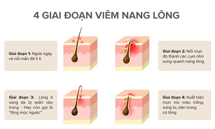 Triệu chứng của viêm nang lông