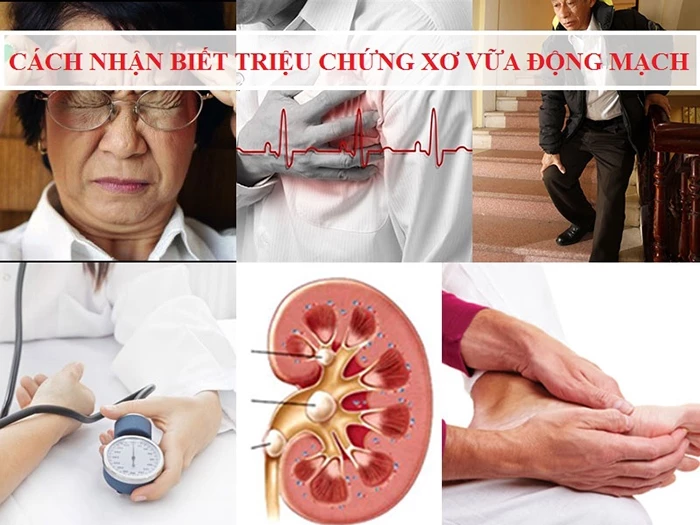 Triệu chứng của xơ vữa động mạch