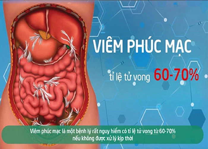 Viêm phúc mạc là gì