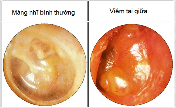 Viêm tai giữa là gì