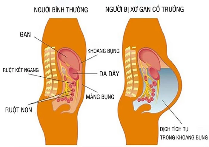 Xơ gan cổ trướng là gì