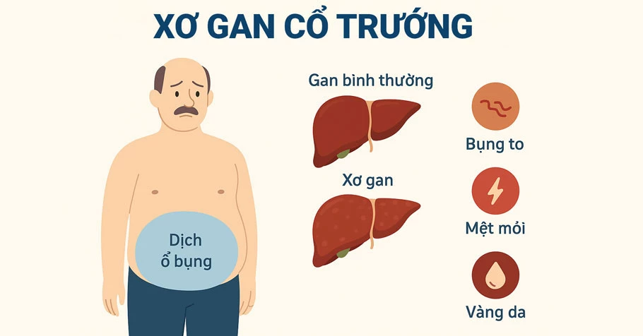 Xơ gan cổ trướng
