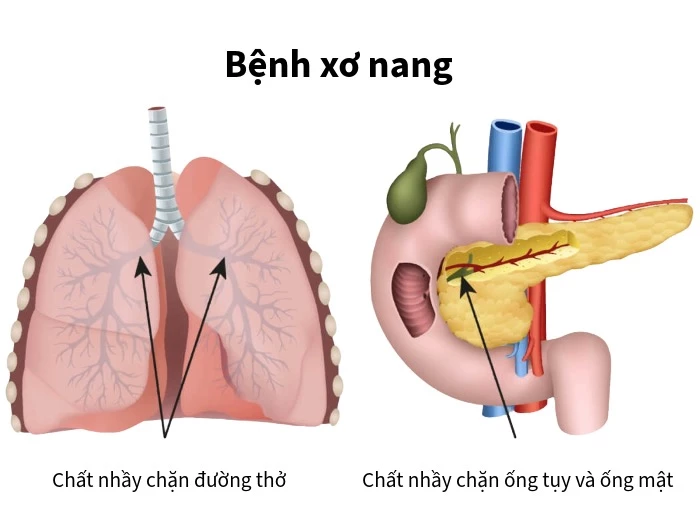 Bệnh xơ nang là gì