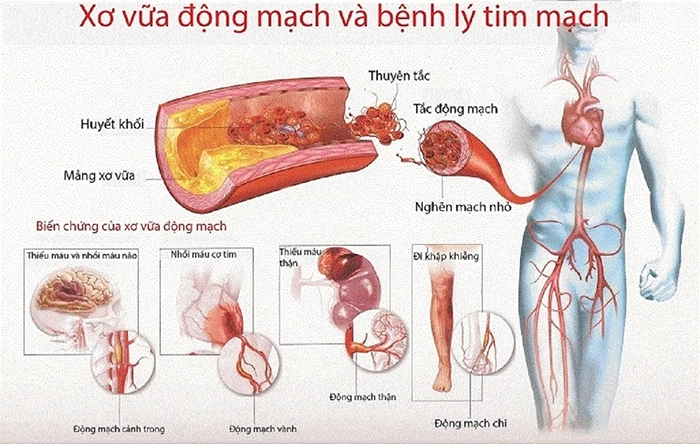 Xơ vữa động mạch là gì